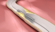 Purchasing Insight: Coronary Stents